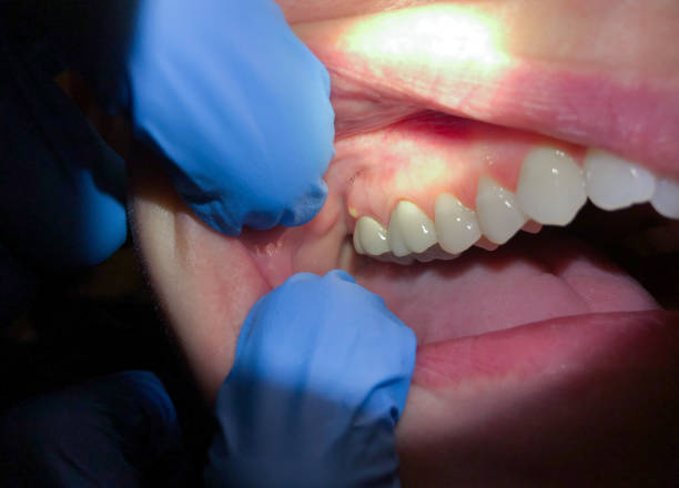 Best Emergency Care for Gum Disease in Athens, AL