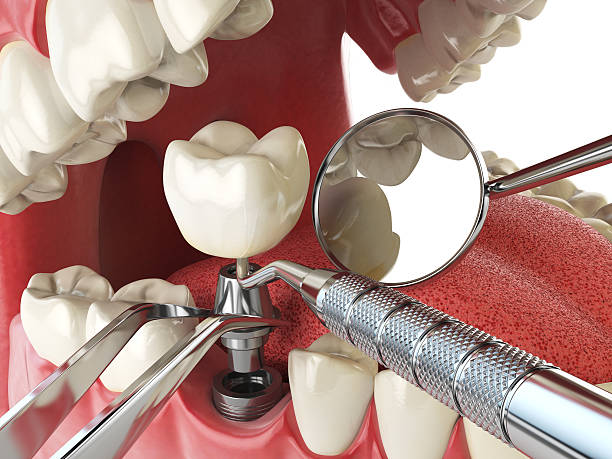 Best Dental Abscess Treatment in Athens, AL